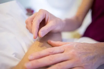 ACUPUNCTURE-TREATMENT