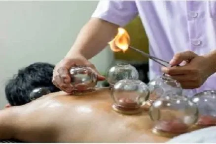CUPPING-THERAPY